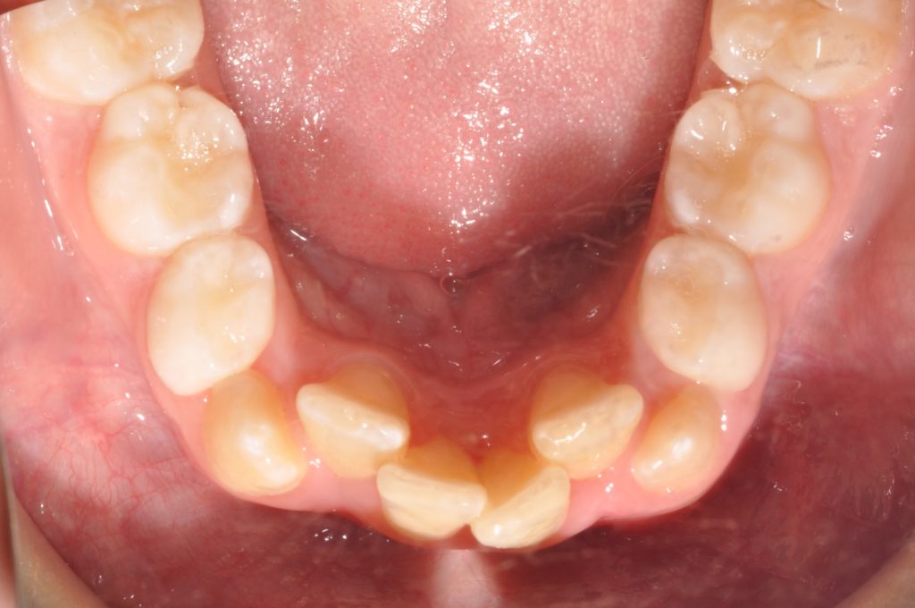 Crowded Teeth Problem